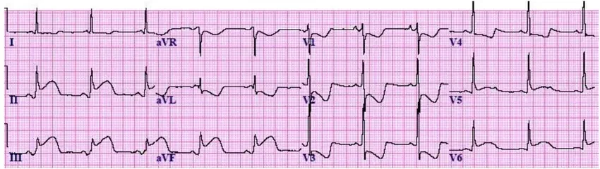 7 acute inferior stemi