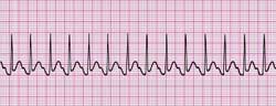 Electrocardiogram (ECG) strip showing rapid, regular heartbeats consistent with supraventricular tachycardia on a red grid background.