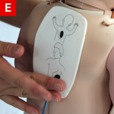 BLS Figure 12 E Ensure wires are attached to the AED box
