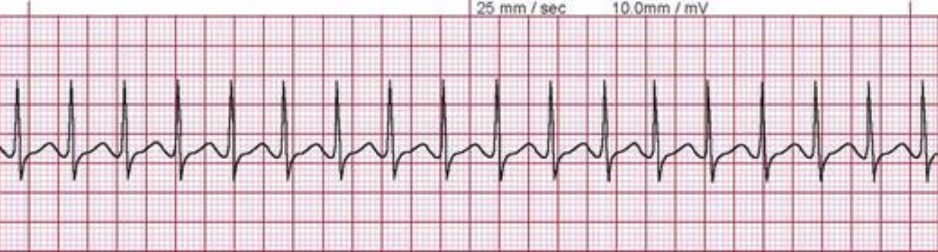 Supraventricular Tachycardia
