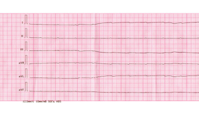 Pulseless Electrical Activity1