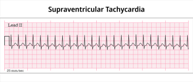 Supraventricular Tachycardia - Electrocardiography Paper