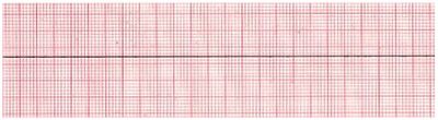 Asystole