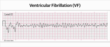 Ventricular Fibrillation Rhythm