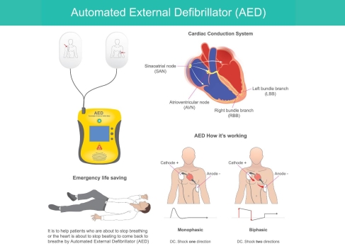 Diagram explaining how an Automated External Defibrillator (AED) works, showing pad placement, heart conduction system, emergency use, and monophasic versus biphasic shock directions.