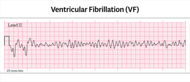 ECG strip showing ventricular fibrillation (VF) with irregular, uncoordinated waveforms and no identifiable QRS complexes on a grid background.