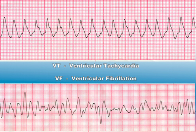 ECG strips showing ventricular tachycardia (VT) on the top and ventricular fibrillation (VF) on the bottom, with labels for each rhythm on a blue background.