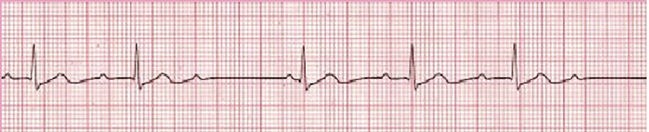 Symptomatic Bradycardia - ACLS Online Handbook