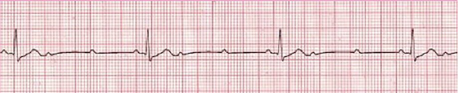 Symptomatic Bradycardia - ACLS Online Handbook