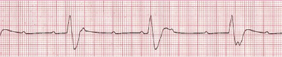 Symptomatic Bradycardia - ACLS Online Handbook