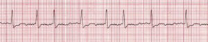 Stable vs. Unstable Tachycardia - ACLS Online Handbook