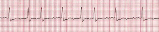 Stable vs. Unstable Tachycardia - ACLS Online Handbook