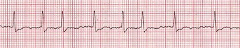 Stable vs. Unstable Tachycardia - ACLS Online Handbook