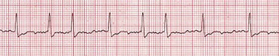 Stable vs. Unstable Tachycardia - ACLS Online Handbook