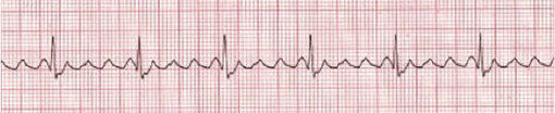 Stable vs. Unstable Tachycardia - ACLS Online Handbook