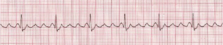 Stable vs. Unstable Tachycardia - ACLS Online Handbook