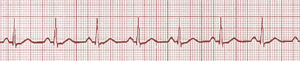 Pulseless Electrical Activity & Asystole - ACLS Online Handbook