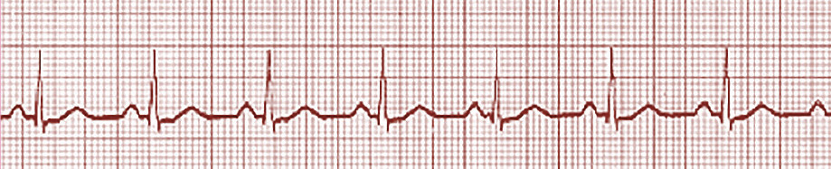 pulseless electrical activity image