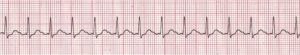 Stable vs. Unstable Tachycardia - ACLS Online Handbook