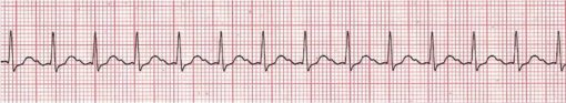 Stable Vs. Unstable Tachycardia - Acls Online Handbook