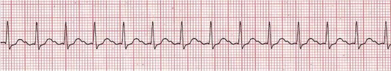 Stable vs. Unstable Tachycardia - ACLS Online Handbook