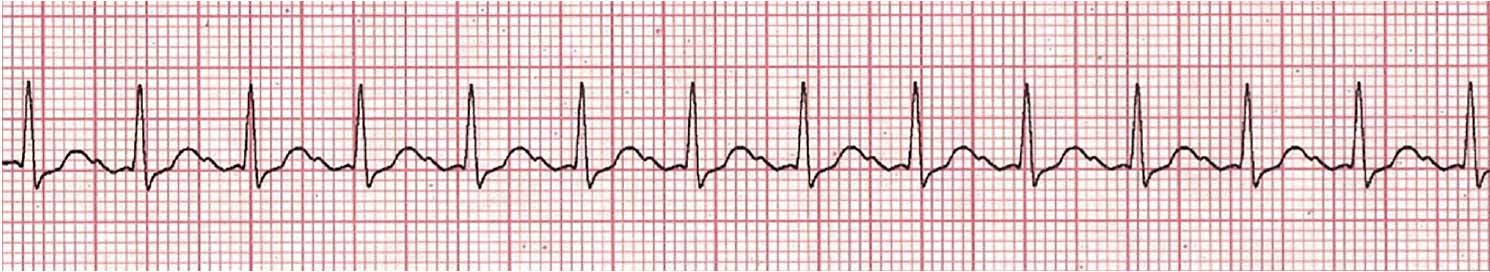 Stable vs. Unstable Tachycardia - ACLS Online Handbook