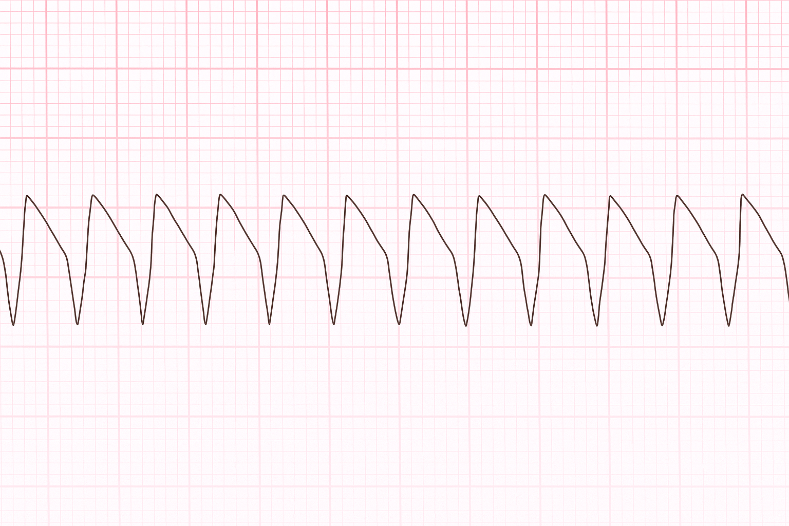 ACLS-Figure-25 Figure 24