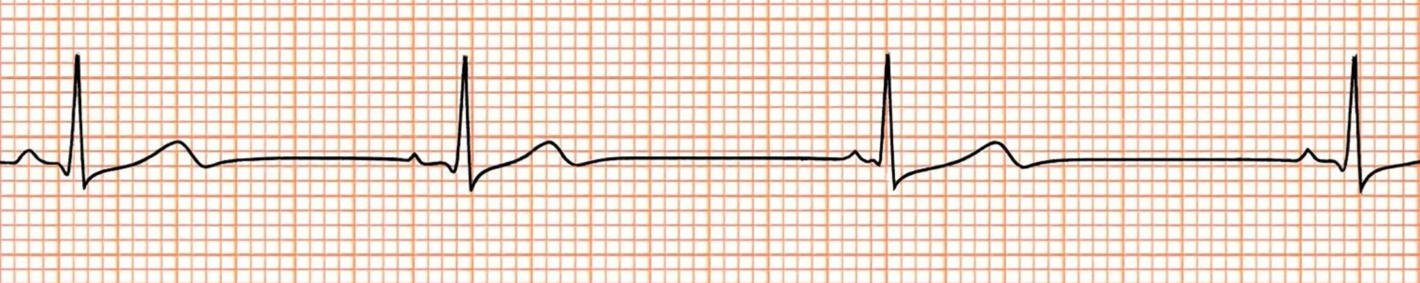 ACLS-Figure-30-_1_-2048x409 Figure 30