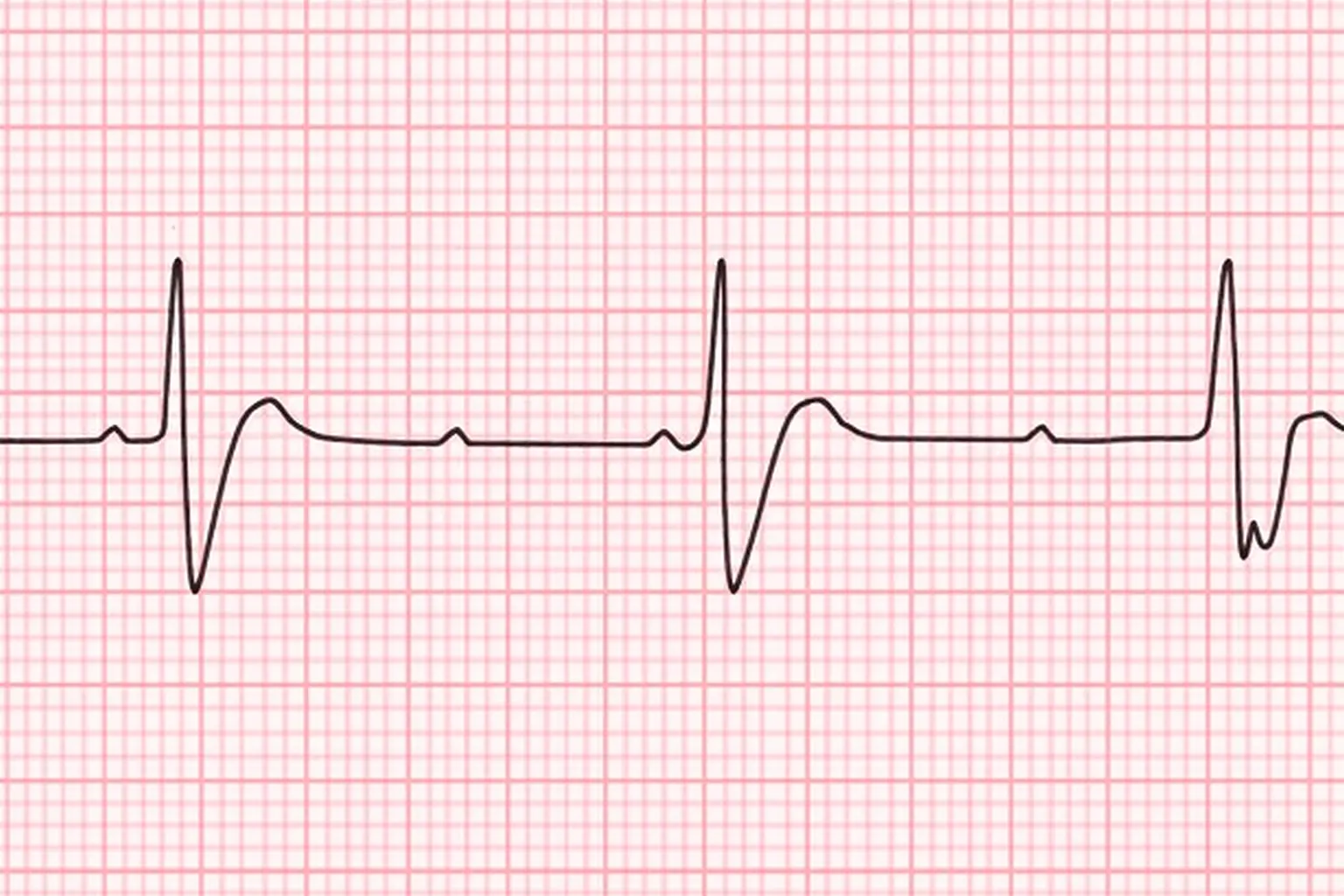 ACLS-Figure-34 Figure 34