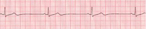 Symptomatic Bradycardia - ACLS Online Handbook