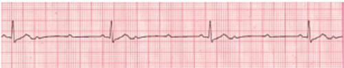 Symptomatic Bradycardia - ACLS Online Handbook