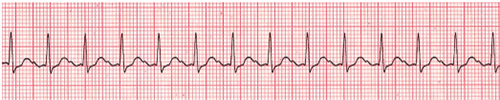 Stable vs. Unstable Tachycardia - ACLS Online Handbook