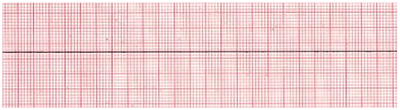 Asystole