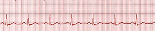 Pulseless electrical activity