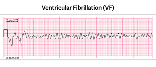 ventricular fibrillation algorithm