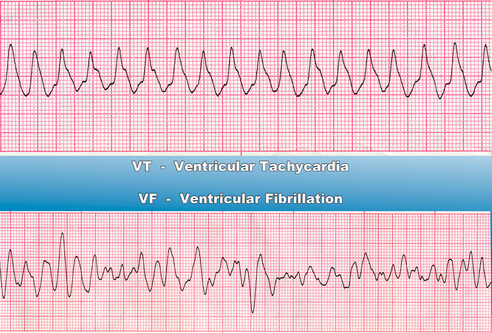 Ventricular Tachycardia vs. Ventricular Fibrillation